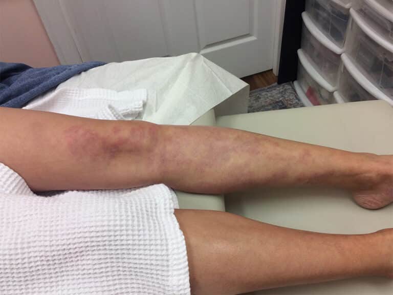 After Image: Port Wine Leg - front