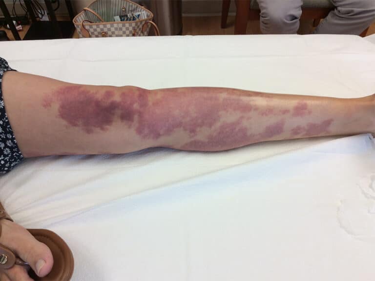 Before Image: Port Wine Leg - front
