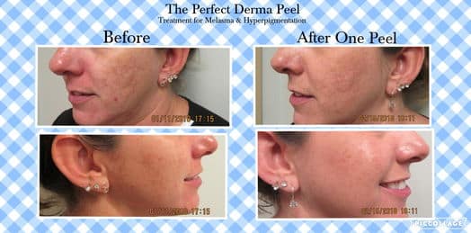 collage perfect derma