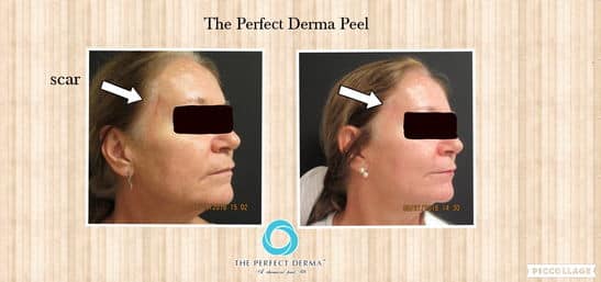 facebook perfect derma scar