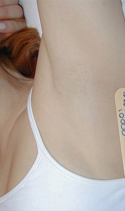 After Image: Hair Removal – Underarm - front