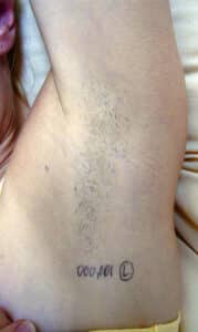 Before Image: Hair Removal – Underarm