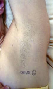 Hair Removal – Underarm