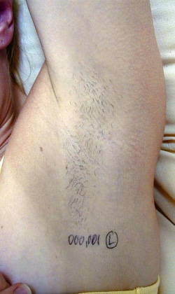 Before Image: Hair Removal – Underarm - front