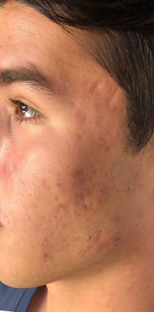 After Image: Hydrafacial - left-side