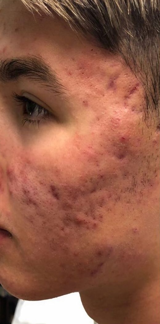 Before Image: Hydrafacial - left-side