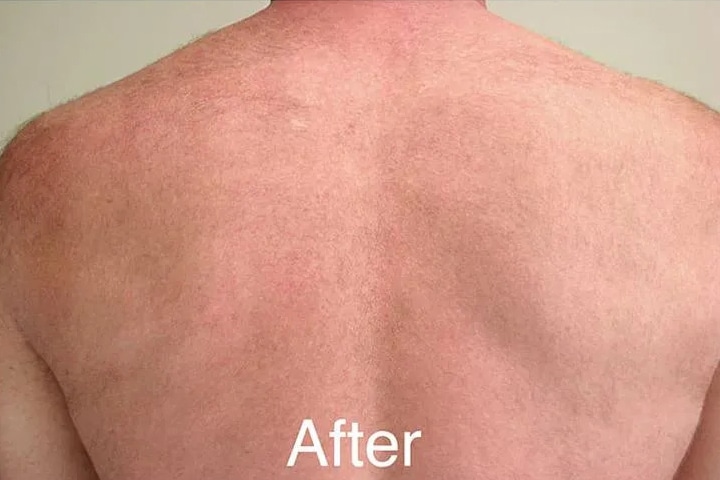 After Image: Laser Hair Removal – Back - front