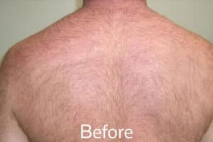 Before Image: Laser Hair Removal – Back
