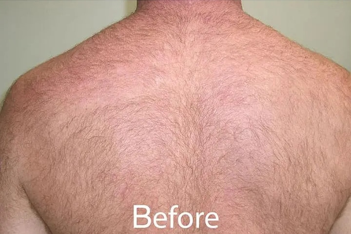 Before Image: Laser Hair Removal – Back - front