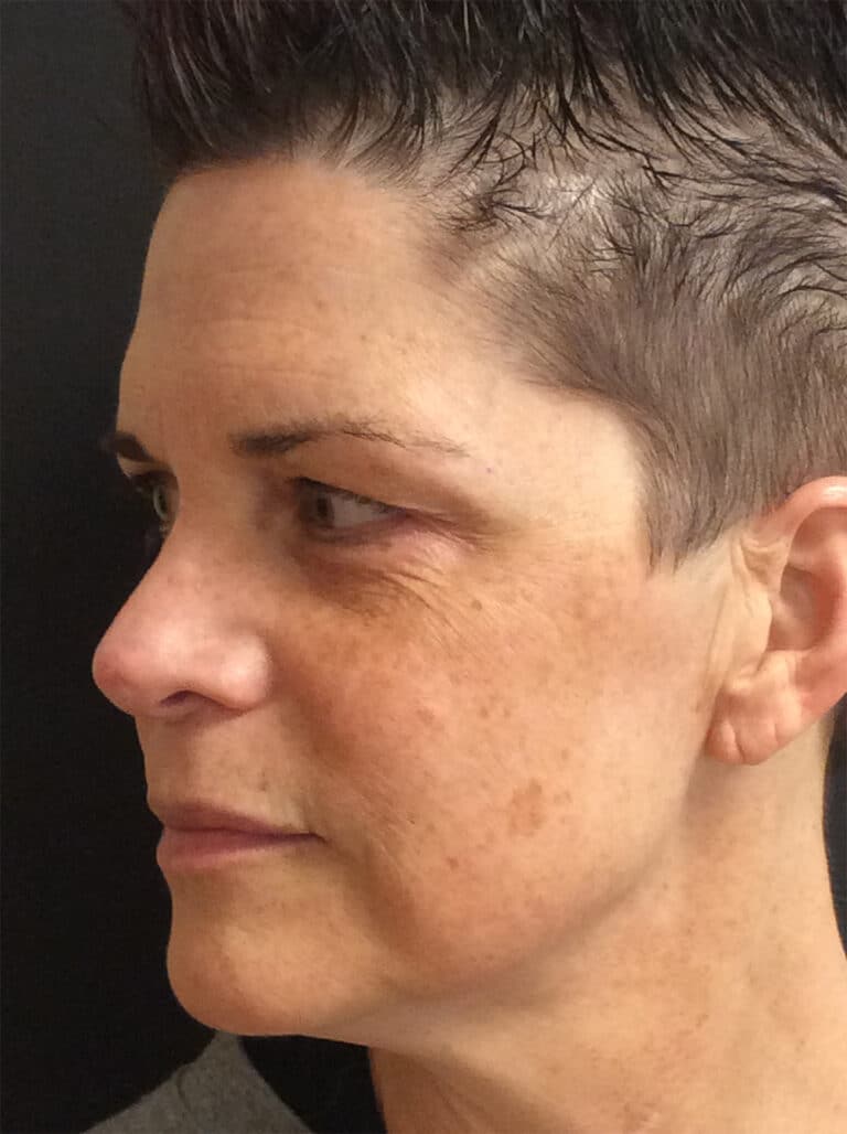 Before Image: Perfect Derma Peel - left-front-oblique