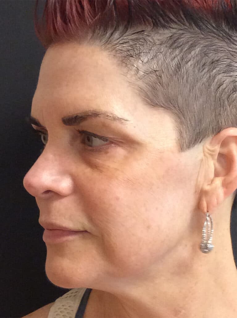 After Image: Perfect Derma Peel - left-front-oblique