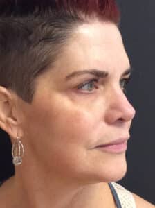 After Image: Perfect Derma Peel