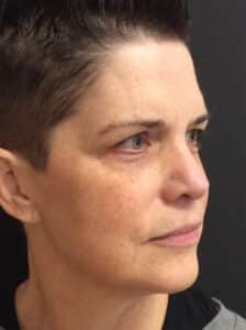 Before Image: Perfect Derma Peel