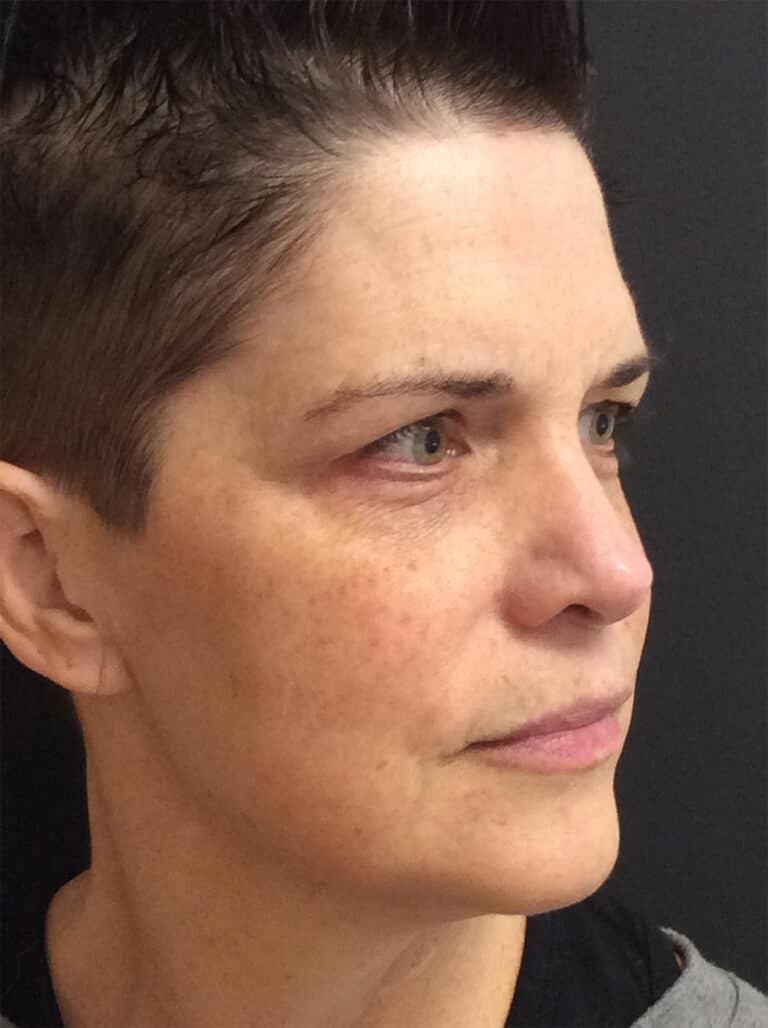 Before Image: Perfect Derma Peel - right-front-oblique