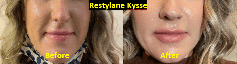 restylane