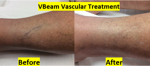 vascular treatment