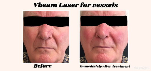 vbeam vessels