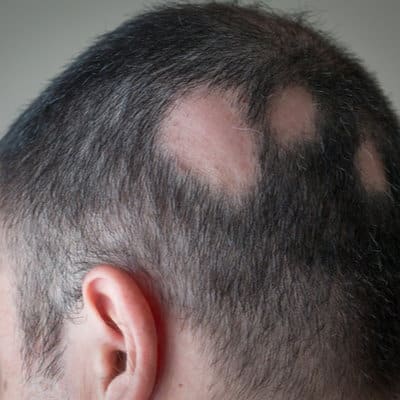 Alopecia Areata 64bed152b83d5.jpeg