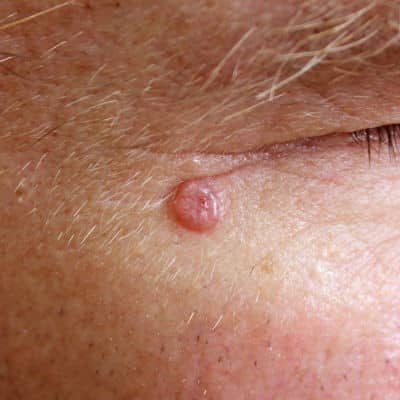 Basal Cell Carcinoma 64bed163d94d9.jpeg