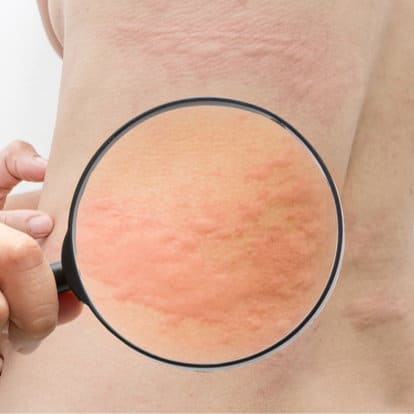 Hives (Urticaria) 64bed309de7e9.jpeg