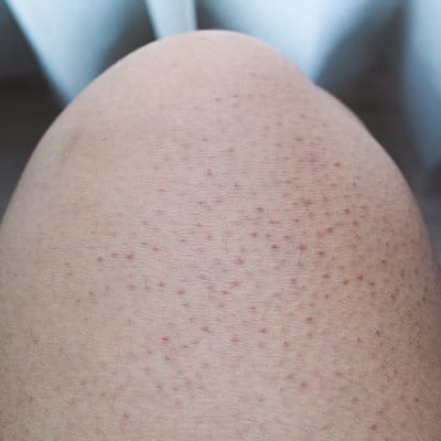 Keratosis Pilaris 64bed3d820362.jpeg