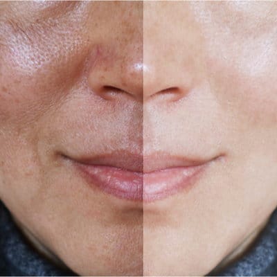 Melasma 64bed43d598e5.jpeg