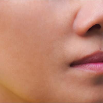 Melasma:Tips to Make It Less Noticeable 64bed46316956.jpeg