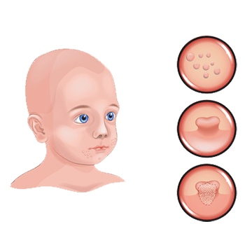 Molluscum Contagiosum 64bed47ead2e5.png