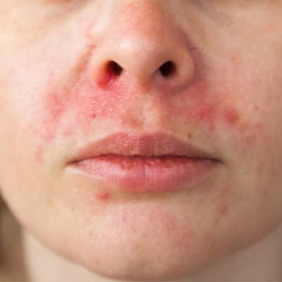 Perioral Dermatitis 64bed49159af2.jpeg