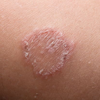 Ringworm (Tinea Corporis) 64bed4cd2d753.jpeg