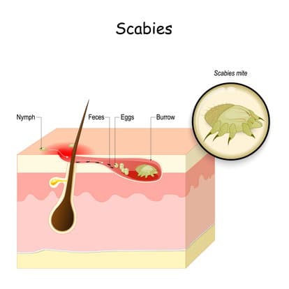 Scabies 64bed4e147567.jpeg