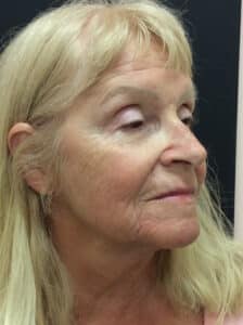 Before Image: Perfect Derma Peel