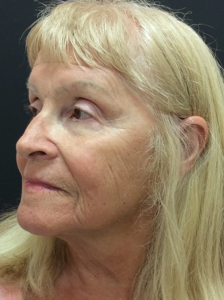Before Image: Perfect Derma Peel - left-front-oblique