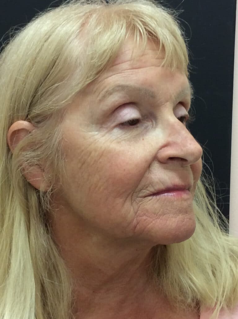 Before Image: Perfect Derma Peel - right-front-oblique