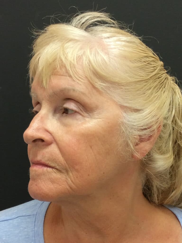After Image: Perfect Derma Peel - left-front-oblique