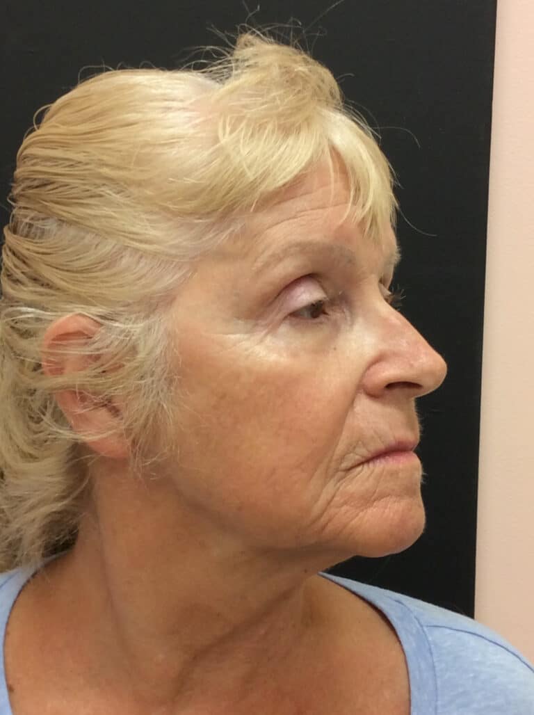 After Image: Perfect Derma Peel - right-front-oblique