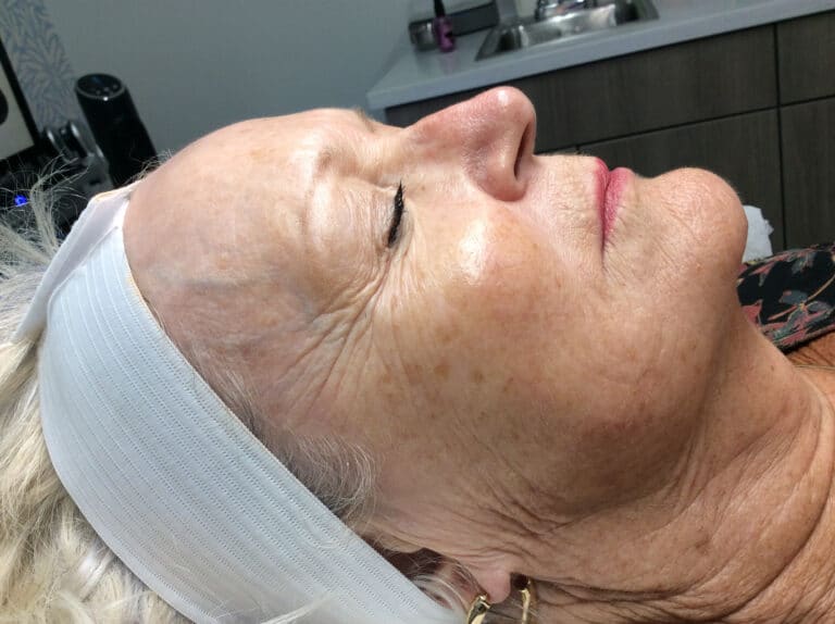 After Image: VI Peel-Precision Plus - right-side