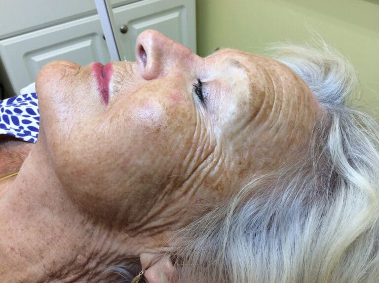 Before Image: VI Peel-Precision Plus - left-side