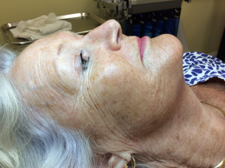 Before Image: VI Peel-Precision Plus - right-side