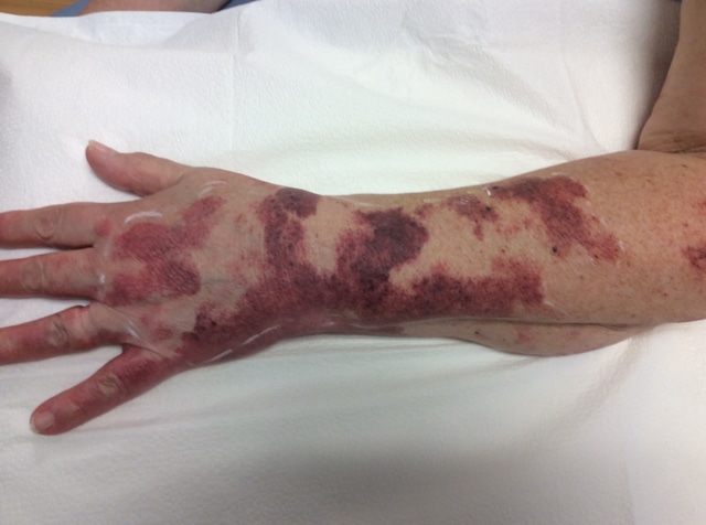 Before Image: Port Wine Hand - front