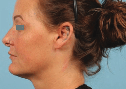 After Image: Matrix Pro RF Applicator Chin and Jaw Area -