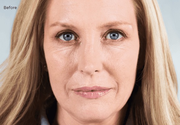Before Image: Sculptra - front