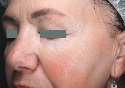 After Image: Sublative RF Applicator - left-side