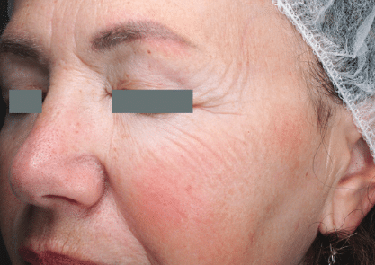 Before Image: Sublative RF Applicator - left-side
