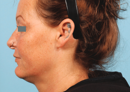 Before Image: Matrix Pro RF Applicator Chin and Jaw Area -
