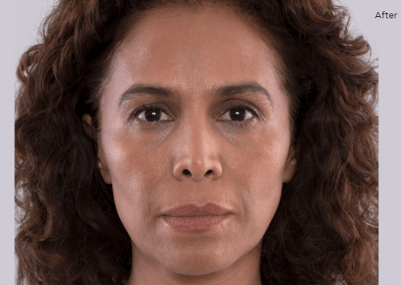 After Image: Sculptra - front
