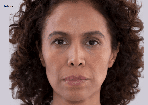 Before Image: Sculptra - front
