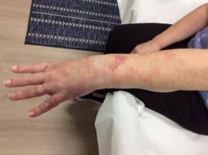 After Image: Port Wine Hand