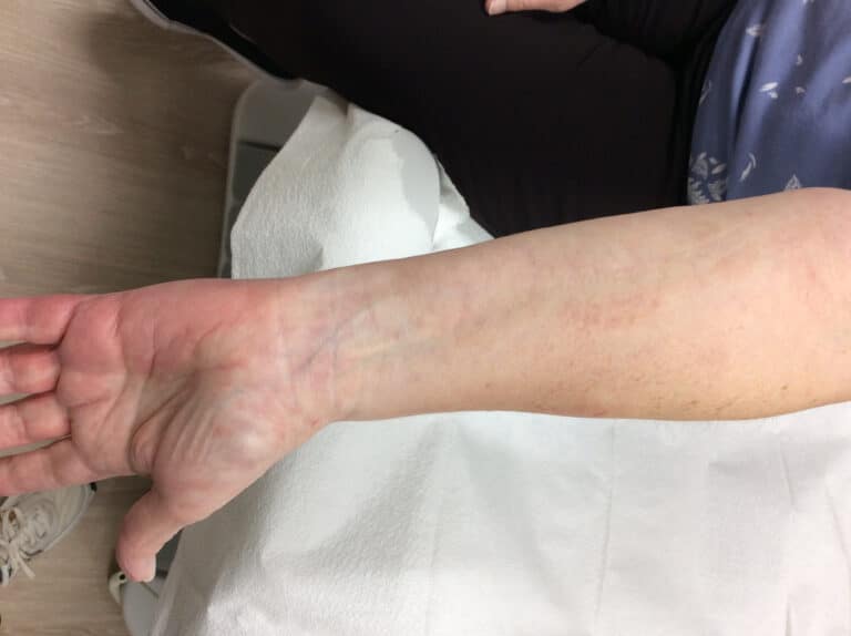 After Image: Port Wine Hand - back