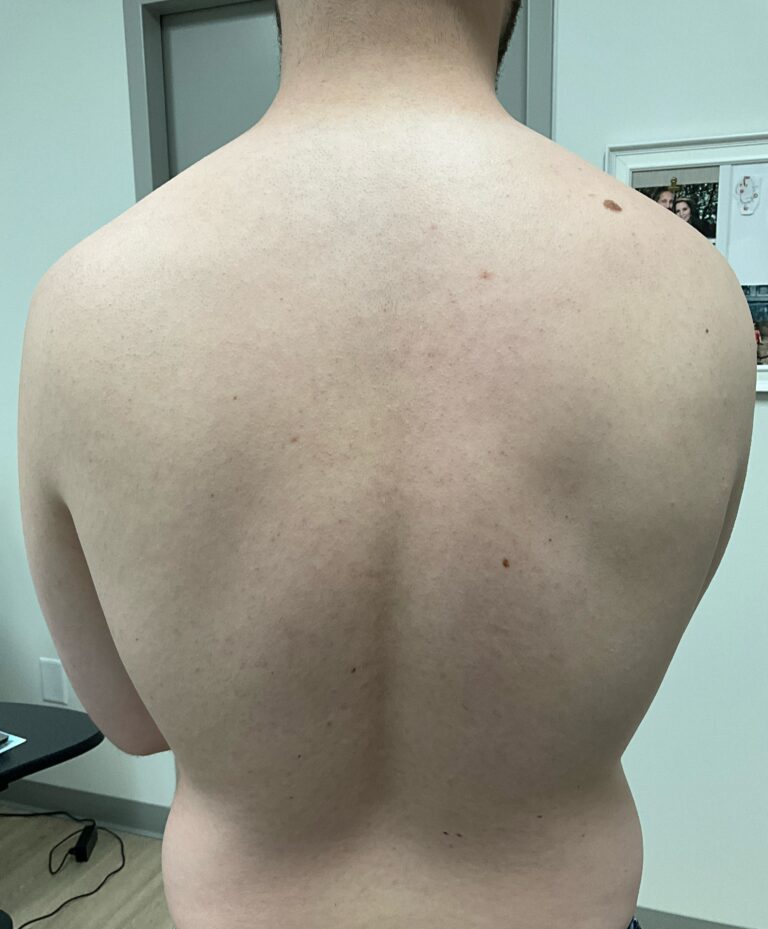After Image: Laser Hair Removal – Back - back